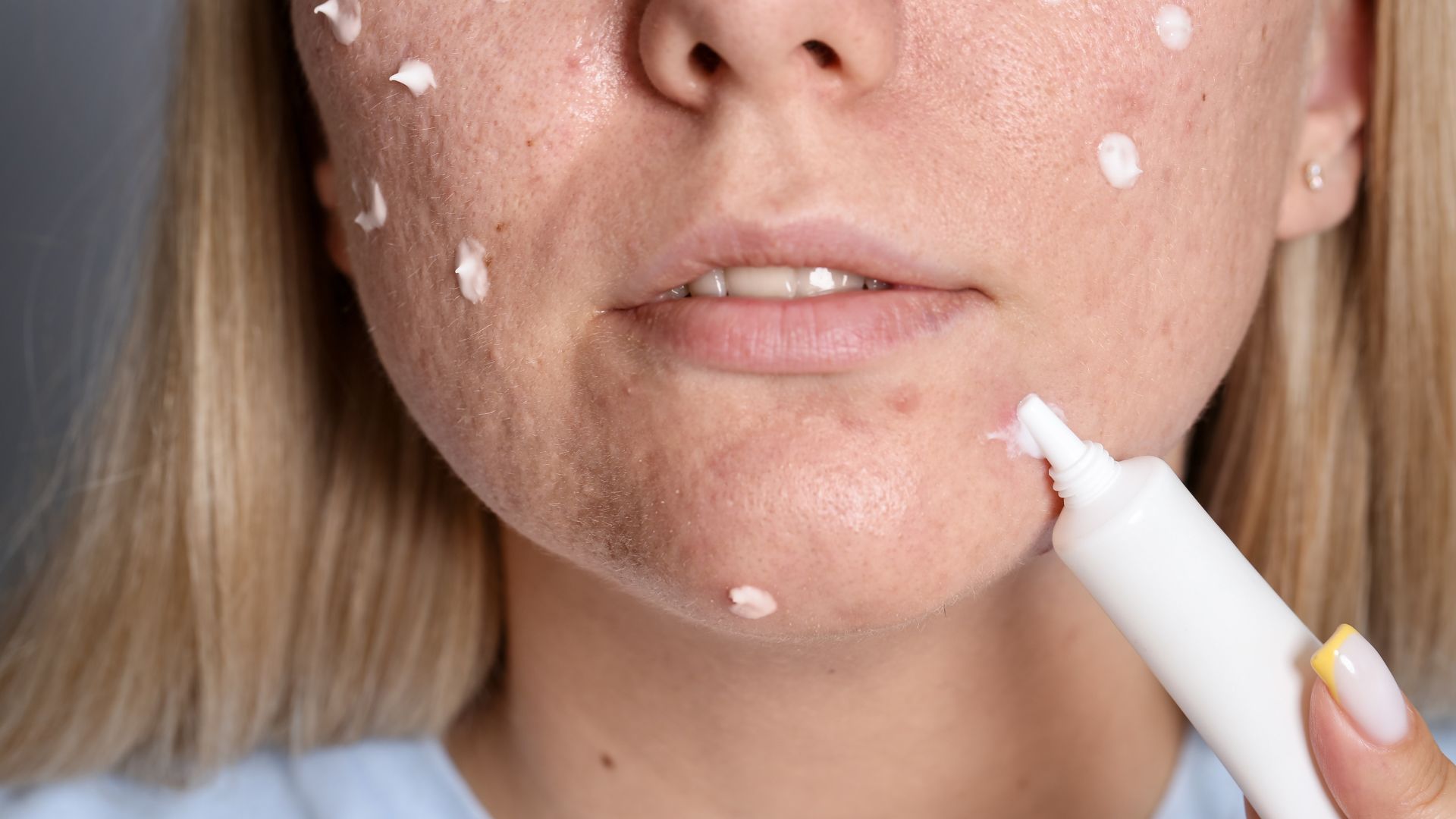 Espinha e acne são a mesma coisa? Descubra!