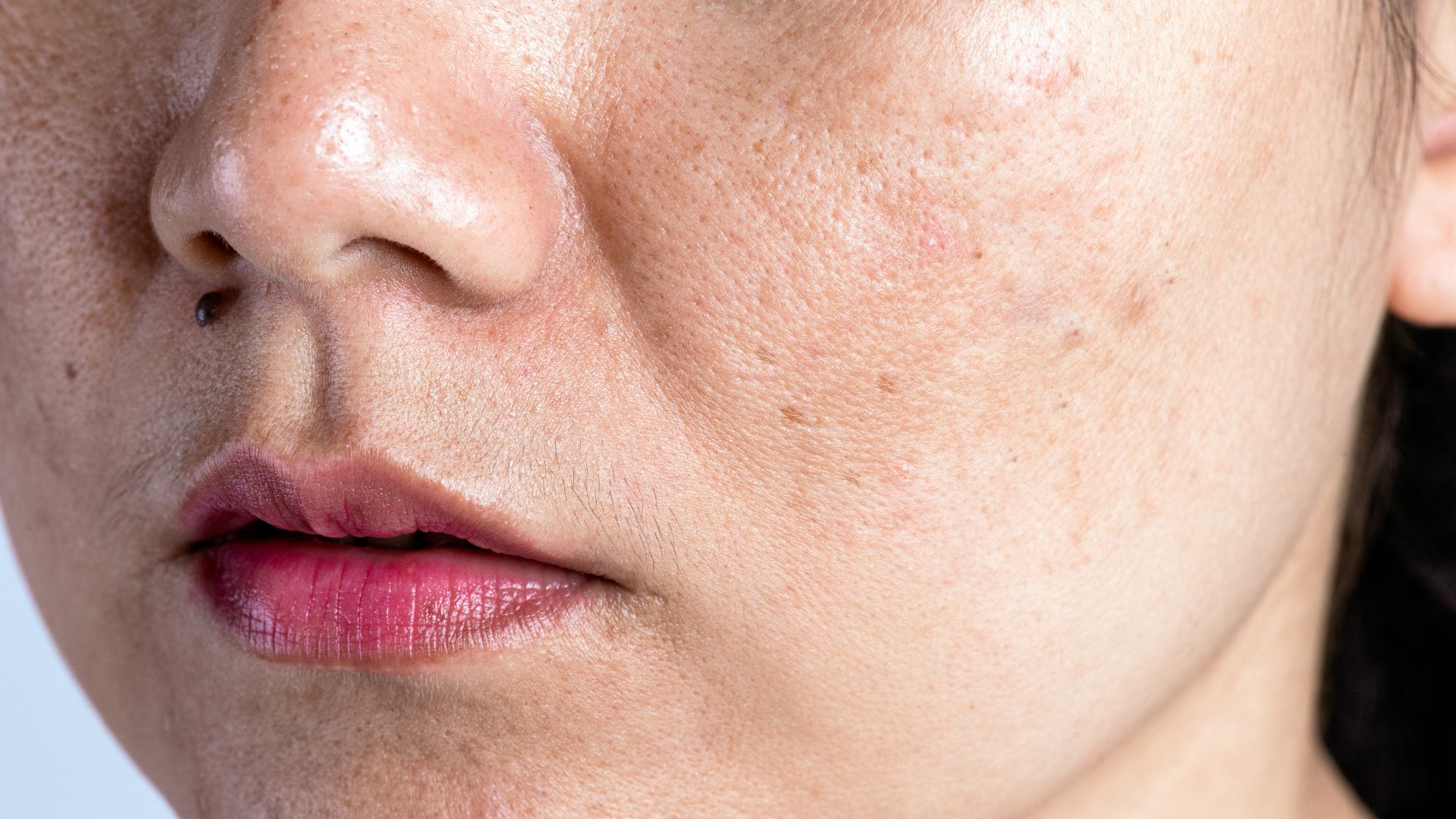 melasma na pele mulher com melasma